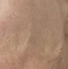Fadenlifting Gesicht