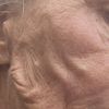 Fadenlifting Gesicht