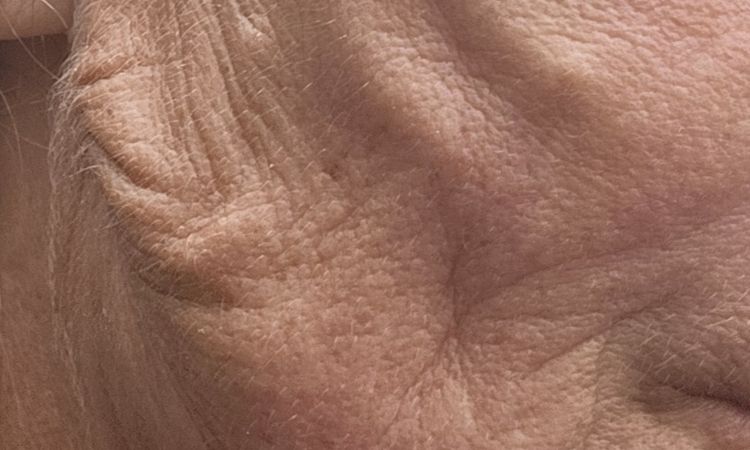 Fadenlifting Gesicht - 81814