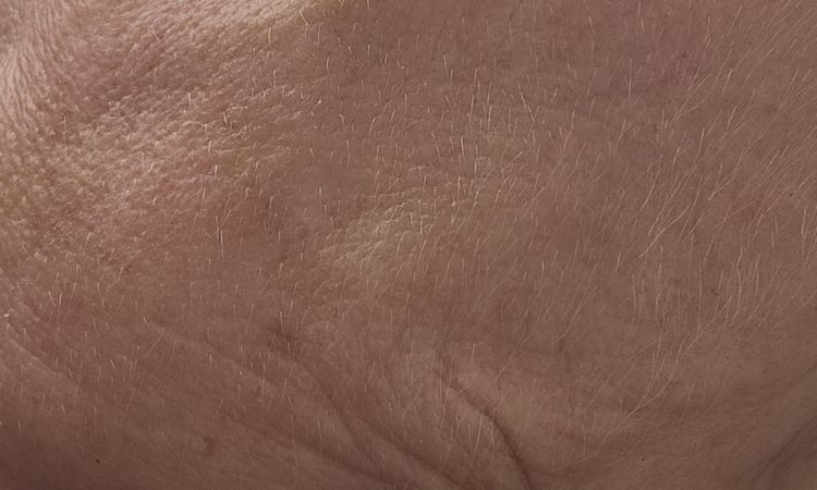 Fadenlifting Gesicht - 81815
