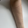 Behandlungsmöglichkeiten bei tiefen SVV Narben