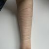 Behandlungsmöglichkeiten bei tiefen SVV Narben
