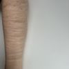 Behandlungsmöglichkeiten bei tiefen SVV Narben