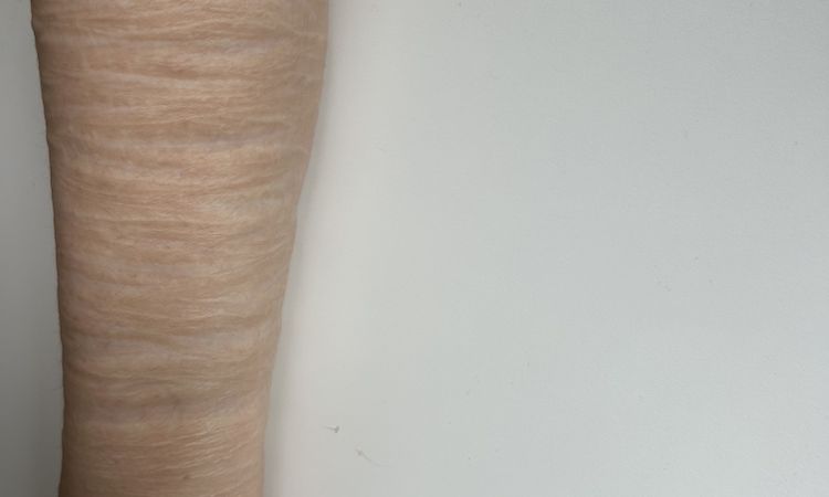 Behandlungsmöglichkeiten bei tiefen SVV Narben - 81842