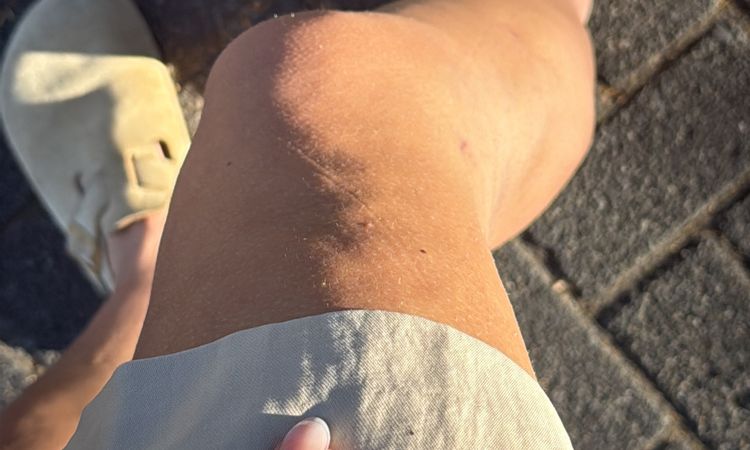 Dellen nach Liposuktion - 81846