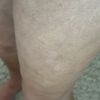 Dellen nach Liposuktion