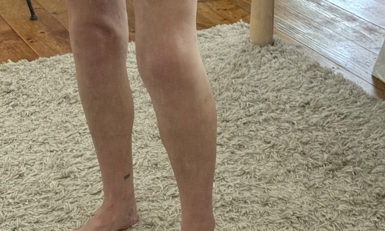 Dellen nach Liposuktion - 81850