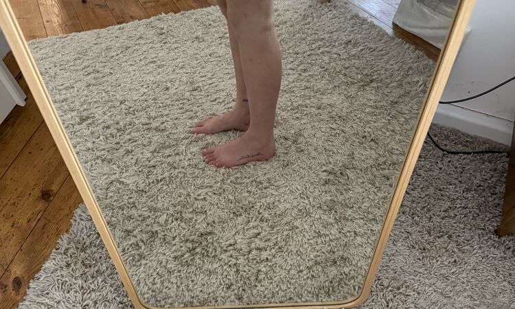 Dellen nach Liposuktion - 81851