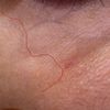 Misslungener Skin Booster mit Restylane