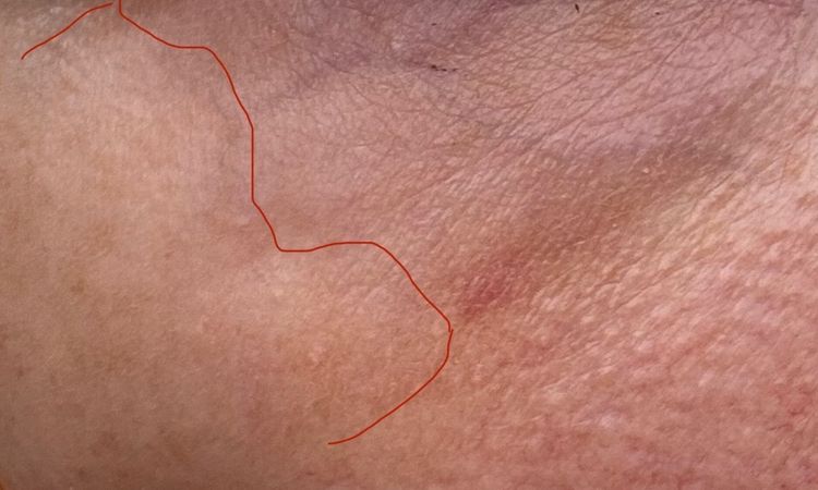 Misslungener Skin Booster mit Restylane - 81859