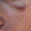 Misslungener Skin Booster mit Restylane