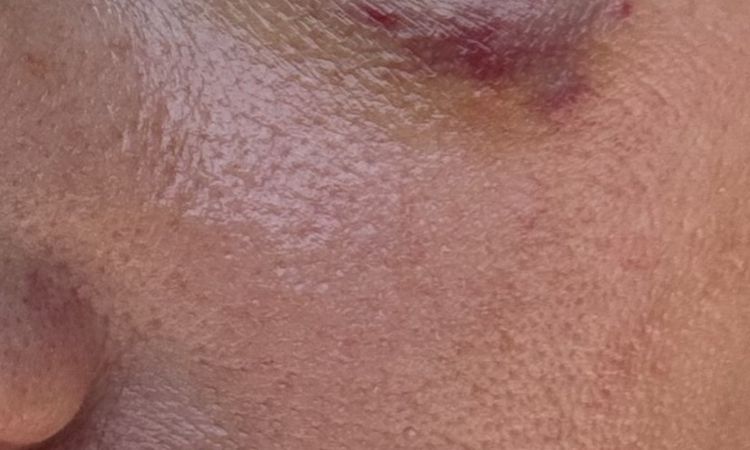Misslungener Skin Booster mit Restylane - 81860