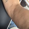 Dellen nach Liposuktion mit Laserstraffung