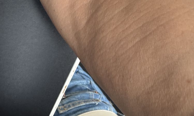 Dellen nach Liposuktion mit Laserstraffung - 81918