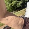 Dellen nach Liposuktion mit Laserstraffung