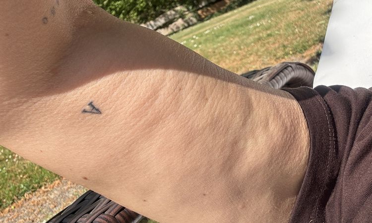 Dellen nach Liposuktion mit Laserstraffung - 81919