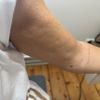 Dellen nach Liposuktion mit Laserstraffung