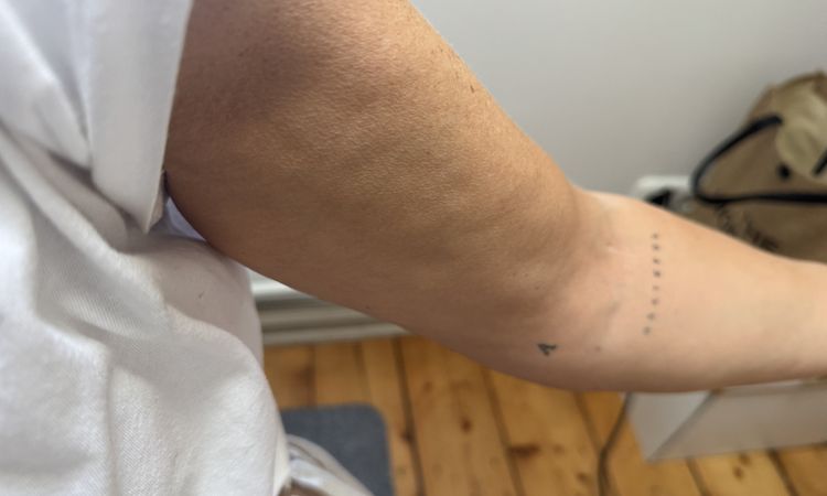 Dellen nach Liposuktion mit Laserstraffung - 81920
