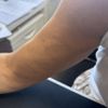 Dellen nach Liposuktion mit Laserstraffung