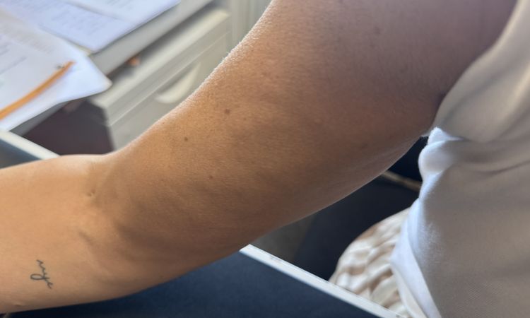 Dellen nach Liposuktion mit Laserstraffung - 81921
