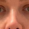 Ungleiche/sichtbare Nasenlöcher und hängende Columella 3 Jahre nach OP
