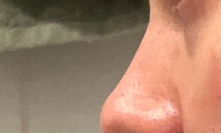 Ungleiche/sichtbare Nasenlöcher und hängende Columella 3 Jahre nach OP - 81943