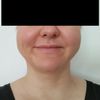 Gesichtsvolumen reduzieren: Facelift / Buccal / Was ganz anderes?