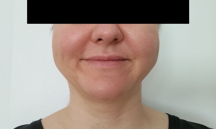 Gesichtsvolumen reduzieren: Facelift / Buccal / Was ganz anderes? - 82032