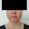 Gesichtsvolumen reduzieren: Facelift / Buccal / Was ganz anderes?