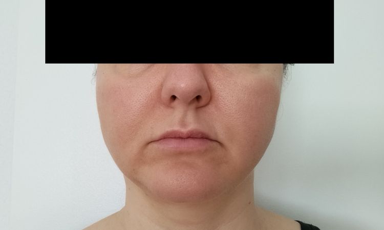 Gesichtsvolumen reduzieren: Facelift / Buccal / Was ganz anderes? - 82033