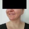Gesichtsvolumen reduzieren: Facelift / Buccal / Was ganz anderes?