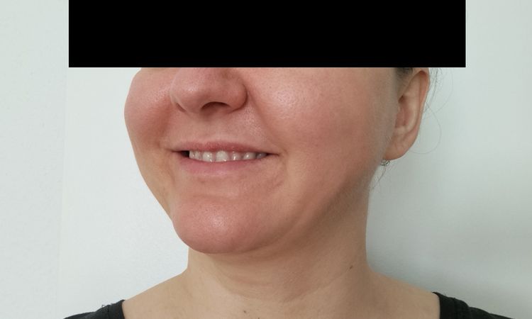 Gesichtsvolumen reduzieren: Facelift / Buccal / Was ganz anderes? - 82034