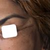 Endoskopisches midfacelift mit Schläfen