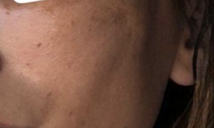 Endoskopisches midfacelift mit Schläfen - 82040