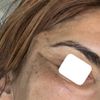 Endoskopisches midfacelift mit Schläfen