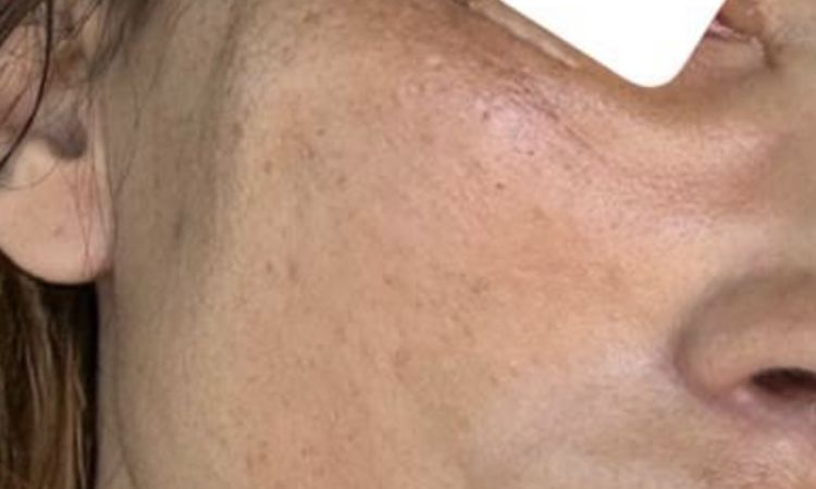 Endoskopisches midfacelift mit Schläfen - 82041