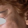 Endoskopisches midfacelift mit Schläfen