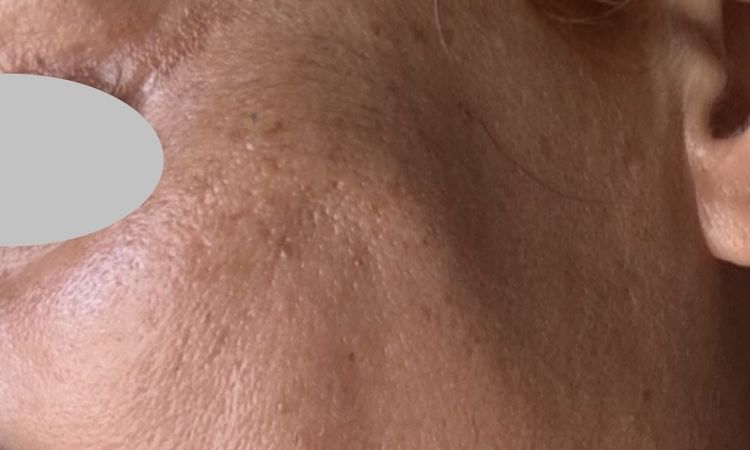 Endoskopisches midfacelift mit Schläfen - 82042