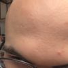 Großflächige Narbe nach Verätzung