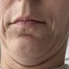 Welche Möglichkeiten der Faltenbehandlung und Straffung habe ich noch?