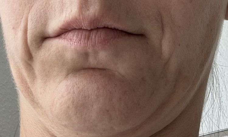 Welche Möglichkeiten der Faltenbehandlung und Straffung habe ich noch? - 82072