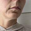 Welche Möglichkeiten der Faltenbehandlung und Straffung habe ich noch?