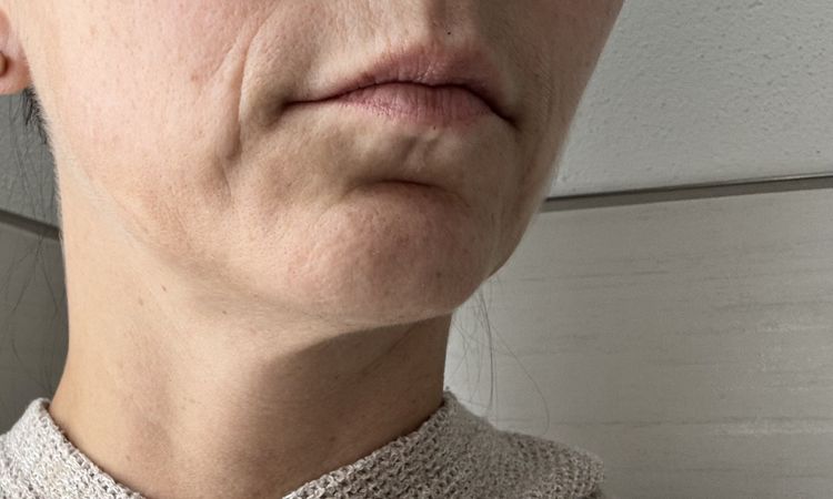 Welche Möglichkeiten der Faltenbehandlung und Straffung habe ich noch? - 82073