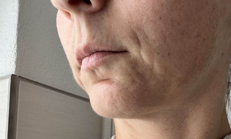 Welche Möglichkeiten der Faltenbehandlung und Straffung habe ich noch? - 82074