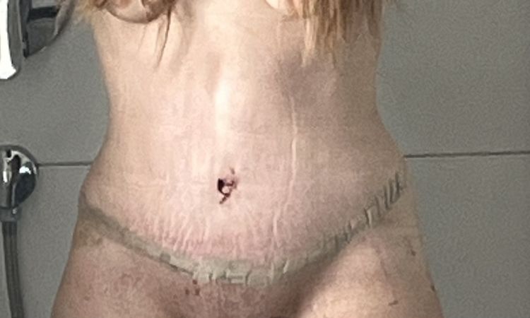 Narbe nicht in der Bikinizone - 82081