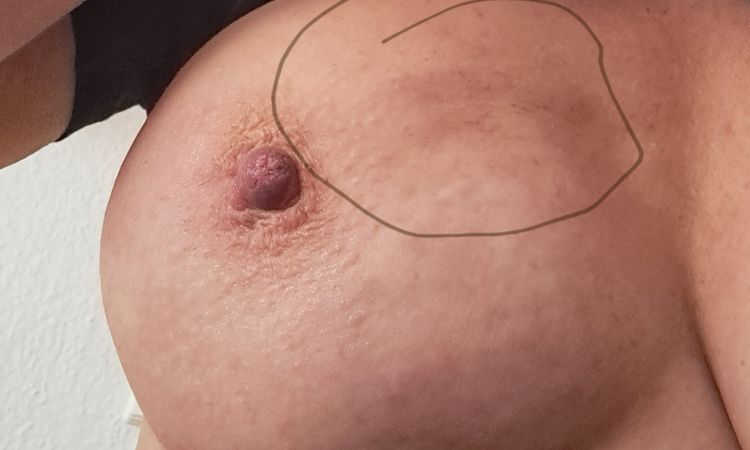 Muskel drückt links auf implantat - 82089