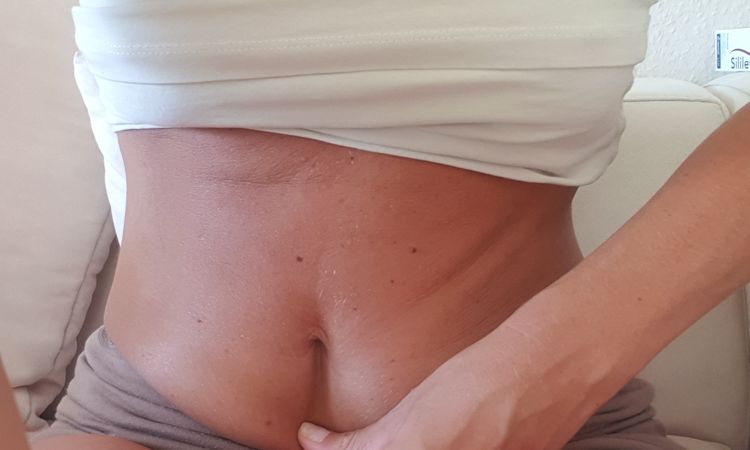 Bauchnabel unten nach Zystenentfernung zu weit nach oben, innen genäht - 82107