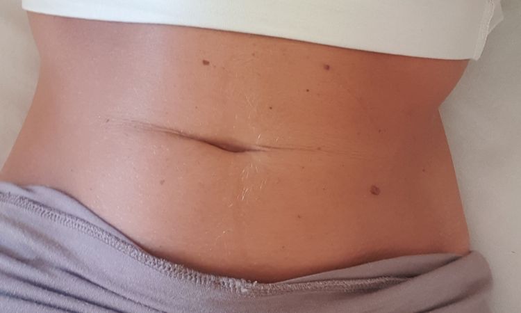 Bauchnabel unten nach Zystenentfernung zu weit nach oben, innen genäht - 82108