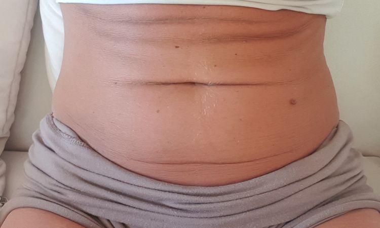 Bauchnabel unten nach Zystenentfernung zu weit nach oben, innen genäht - 82109