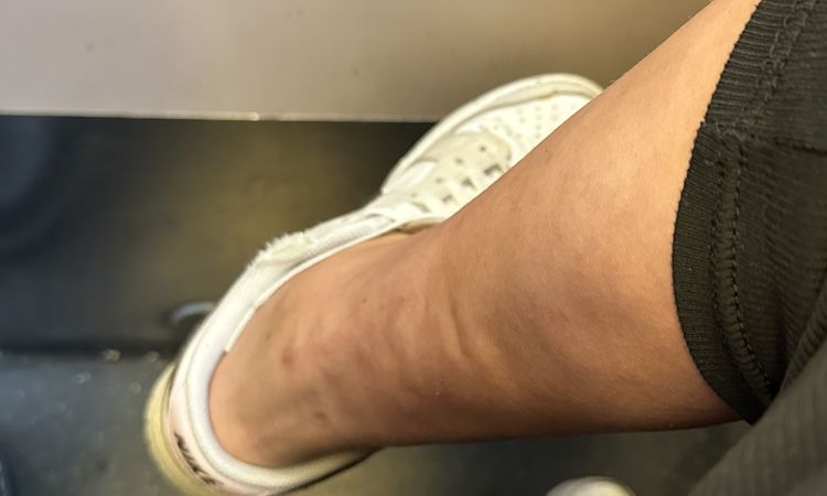Unebenheiten nach Lipödem-Liposuktion - 82128
